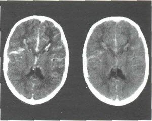 Субарахноидальное кровоизлияние головного мозга